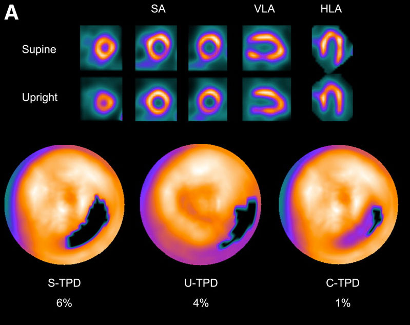 Thallium Scan Advanced Cardiovascular Specialists