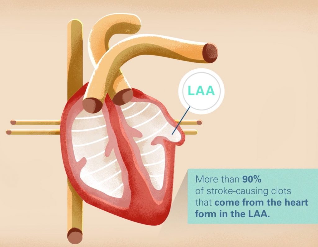 WATCHMAN Left Atrial Appendage Closure Device - Advanced Cardiovascular ...