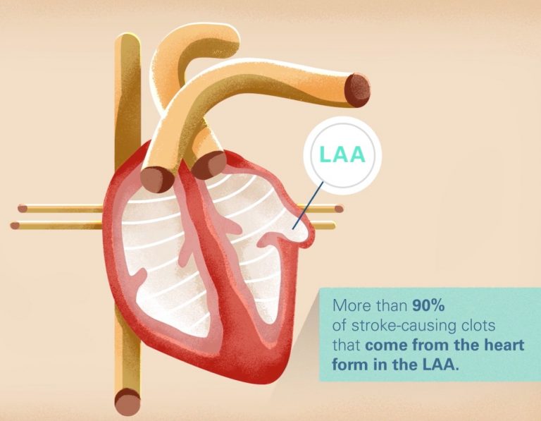 WATCHMAN Left Atrial Appendage Closure Device - Advanced Cardiovascular