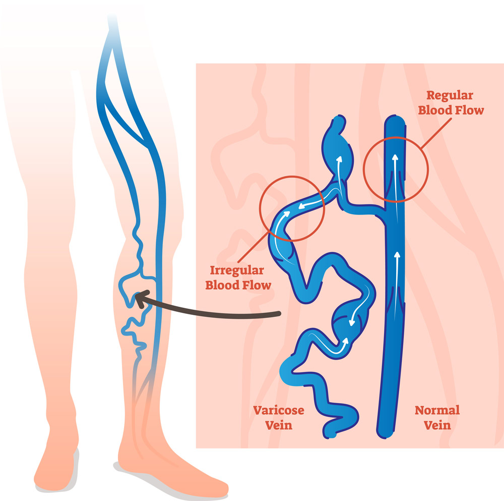 Spider Vein Treatment - Center for Advanced Cardiac and Vascular